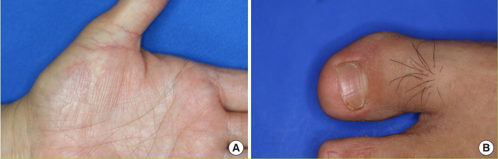 Nail Bed Defect Reconstruction Using A Thenar Fascial Flap And Subsequent Nail Bed Grafting