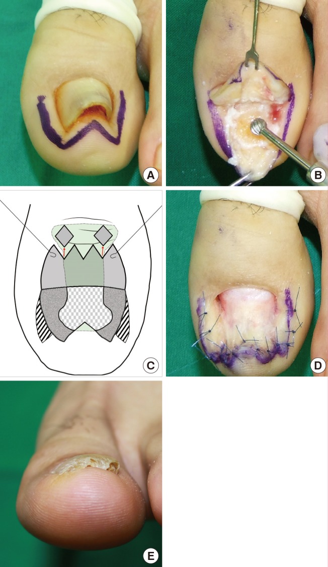 Pincer Nail Deformity: Clinical Characteristics, Causes, and Managements