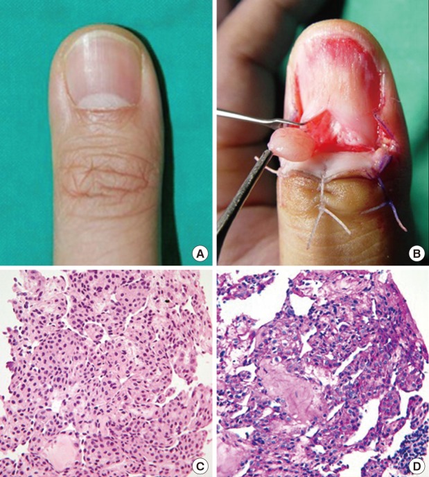 Glomus Tumor - Pathology - Orthobullets